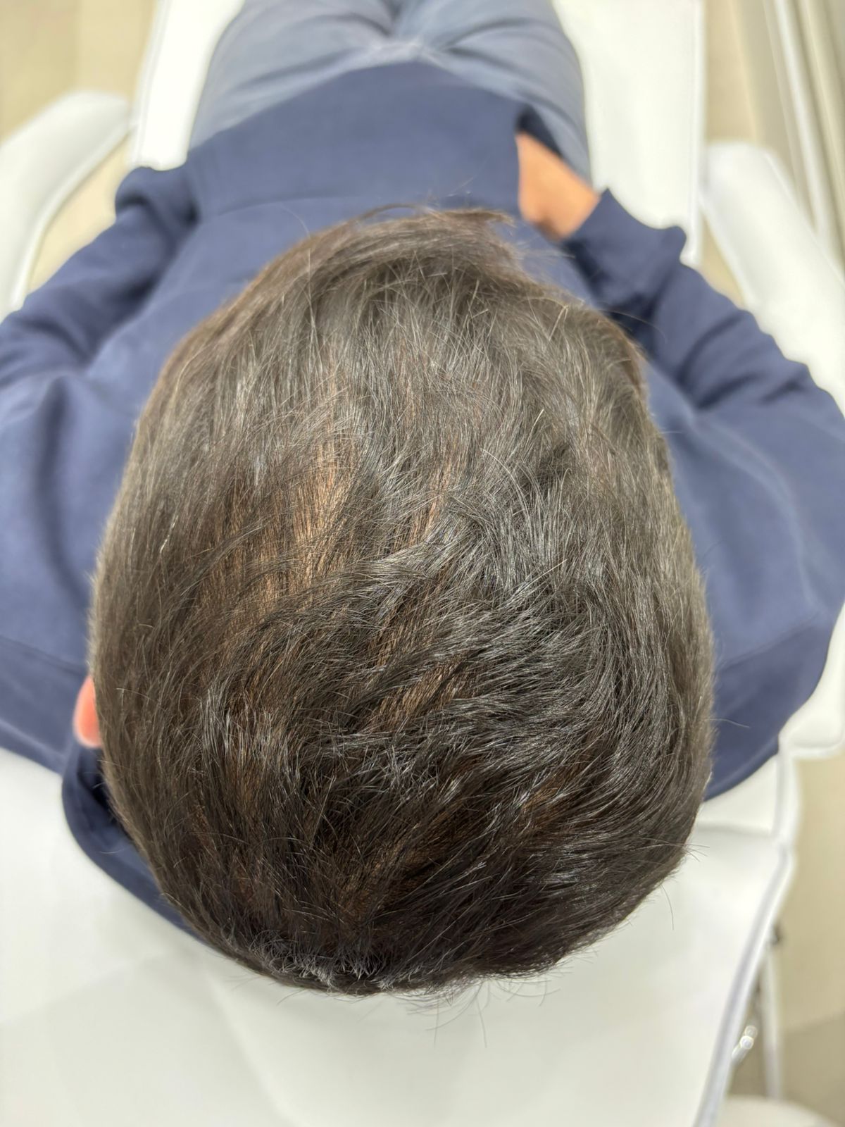 Intradermoterapia Capilar